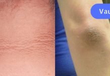 შავი იდაყვების გამო მოკლე სახელოების ჩაცმა მრცხვენოდა. გაოცებული დავრჩი, როცა დავინახე ამ საშუალების ეფექტი!