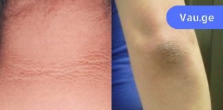 შავი იდაყვების გამო მოკლე სახელოების ჩაცმა მრცხვენოდა. გაოცებული დავრჩი, როცა დავინახე ამ საშუალების ეფექტი!