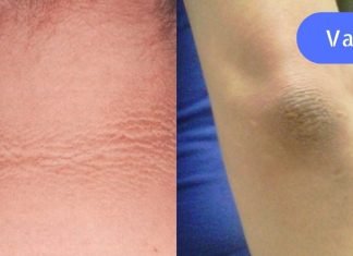 შავი იდაყვების გამო მოკლე სახელოების ჩაცმა მრცხვენოდა. გაოცებული დავრჩი, როცა დავინახე ამ საშუალების ეფექტი!