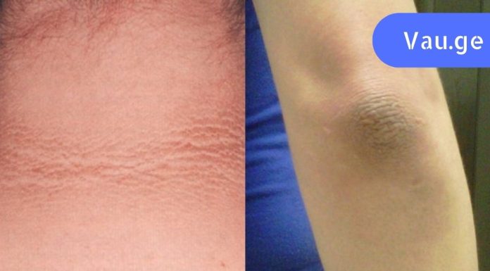 შავი იდაყვების გამო მოკლე სახელოების ჩაცმა მრცხვენოდა. გაოცებული დავრჩი, როცა დავინახე ამ საშუალების ეფექტი!