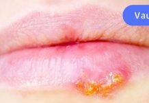 თუ ხშირად გაწუხებთ ჰერპესი, სცადეთ ეს მეთოდი. იმუნიტეტი გაიზრდება!