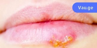 თუ ხშირად გაწუხებთ ჰერპესი, სცადეთ ეს მეთოდი. იმუნიტეტი გაიზრდება!