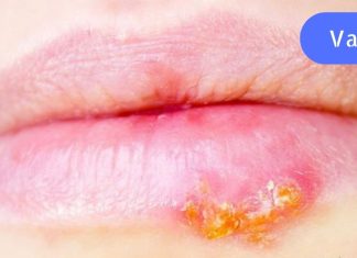 თუ ხშირად გაწუხებთ ჰერპესი, სცადეთ ეს მეთოდი. იმუნიტეტი გაიზრდება!