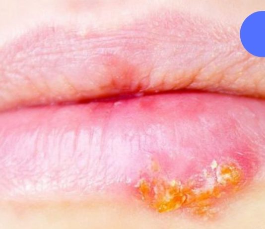 თუ ხშირად გაწუხებთ ჰერპესი, სცადეთ ეს მეთოდი. იმუნიტეტი გაიზრდება!