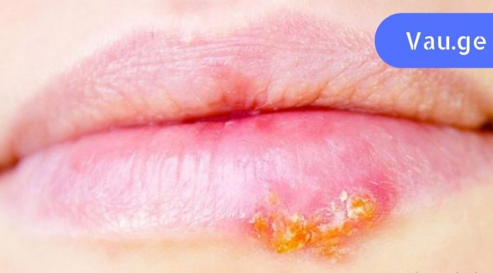 თუ ხშირად გაწუხებთ ჰერპესი, სცადეთ ეს მეთოდი. იმუნიტეტი გაიზრდება!