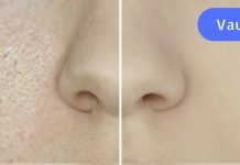 ფორები სახეზე: როგორ დავივიწროთ და გავწმინდოთ. მარტივი და ეფექტური რეკომენდაციები!