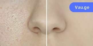 ფორები სახეზე: როგორ დავივიწროთ და გავწმინდოთ. მარტივი და ეფექტური რეკომენდაციები!