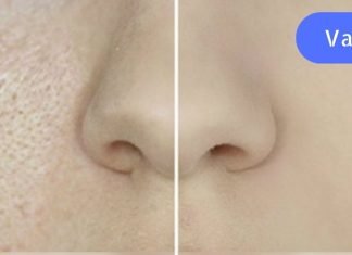 ფორები სახეზე: როგორ დავივიწროთ და გავწმინდოთ. მარტივი და ეფექტური რეკომენდაციები!