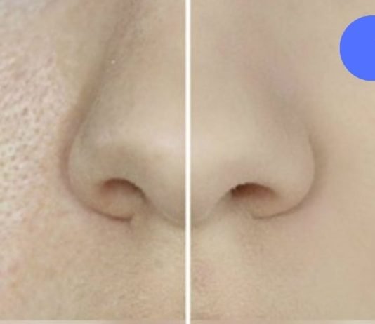 ფორები სახეზე: როგორ დავივიწროთ და გავწმინდოთ. მარტივი და ეფექტური რეკომენდაციები!