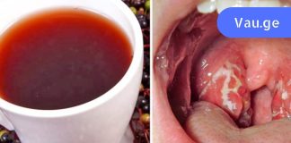 ყელის ტკივილის ბუნებრივი საშუალება: მხოლოდ 4 საათი – და ყელის ტკივილის სიმპტომები გაქრა!