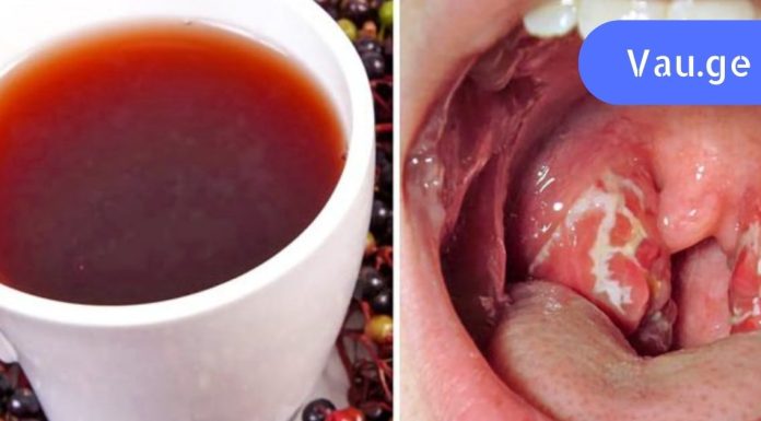 ყელის ტკივილის ბუნებრივი საშუალება: მხოლოდ 4 საათი – და ყელის ტკივილის სიმპტომები გაქრა!