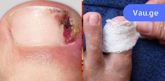 საშინელი ტკივილი! ჩაზრდილი ფრჩხილი დიდხანს მაწუხებდა, სანამ შემთხვევით არ წავაწყდი ამ წამალს.