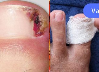 საშინელი ტკივილი! ჩაზრდილი ფრჩხილი დიდხანს მაწუხებდა, სანამ შემთხვევით არ წავაწყდი ამ წამალს.