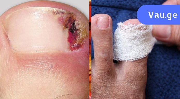 საშინელი ტკივილი! ჩაზრდილი ფრჩხილი დიდხანს მაწუხებდა, სანამ შემთხვევით არ წავაწყდი ამ წამალს.