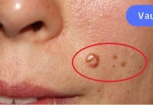 გერმანიის კლინიკის მთავარი ექიმი გვასწავლის – როგორ მოვიშოროთ მეჭეჭები ქირურგიული ჩარევის გარეშე.