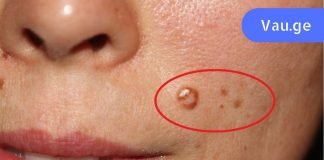 გერმანიის კლინიკის მთავარი ექიმი გვასწავლის – როგორ მოვიშოროთ მეჭეჭები ქირურგიული ჩარევის გარეშე.