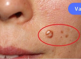 გერმანიის კლინიკის მთავარი ექიმი გვასწავლის – როგორ მოვიშოროთ მეჭეჭები ქირურგიული ჩარევის გარეშე.