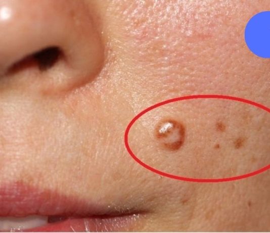 გერმანიის კლინიკის მთავარი ექიმი გვასწავლის – როგორ მოვიშოროთ მეჭეჭები ქირურგიული ჩარევის გარეშე.