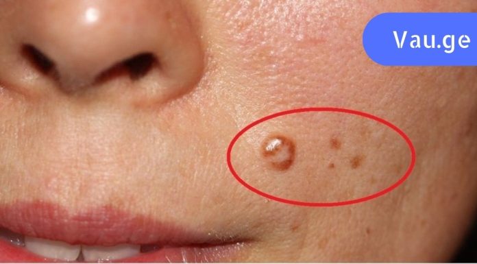 გერმანიის კლინიკის მთავარი ექიმი გვასწავლის – როგორ მოვიშოროთ მეჭეჭები ქირურგიული ჩარევის გარეშე.