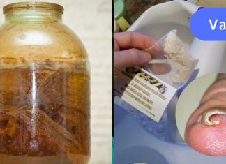 ბაბუის რჩევა ჩაზრდილი ფრჩხილის სამკურნალოდ. ერთხელ და სამუდამოდ მოიშორეთ ეს პრობლემა!