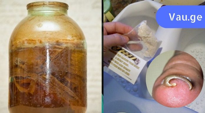 ბაბუის რჩევა ჩაზრდილი ფრჩხილის სამკურნალოდ. ერთხელ და სამუდამოდ მოიშორეთ ეს პრობლემა!