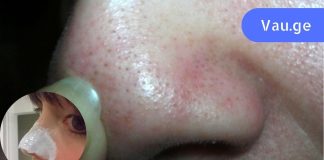 ერთადერთი საშუალება, რომელიც ნამდვილად დამეხმარა შავი წერტილების მოცილებაში! Მე გირჩევ.