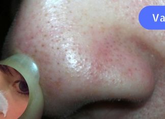 ერთადერთი საშუალება, რომელიც ნამდვილად დამეხმარა შავი წერტილების მოცილებაში! Მე გირჩევ.