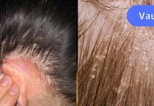 ფრთხილად იყავი ! მეგობარმა ეს შეცდომა დაუშვა. ახლა ის სკალპის სოკოს მკურნალობს!