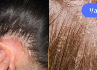 ფრთხილად იყავი ! მეგობარმა ეს შეცდომა დაუშვა. ახლა ის სკალპის სოკოს მკურნალობს!