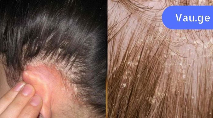 ფრთხილად იყავი ! მეგობარმა ეს შეცდომა დაუშვა. ახლა ის სკალპის სოკოს მკურნალობს!