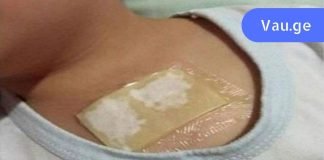 ხსნის ძლიერ ხველას და შლის ლორწოს ფილტვებიდან და ბრონქებიდან სულ რაღაც 1 ღამეში: ეს არის ხსნა.