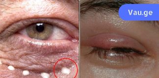 8 სიგნალი, რომლითაც თვალები ჯანმრთელობის პრობლემებზე მიგვანიშნებს,გაიგე მეტი