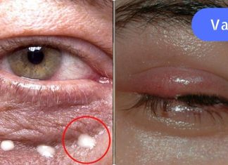 8 სიგნალი, რომლითაც თვალები ჯანმრთელობის პრობლემებზე მიგვანიშნებს,გაიგე მეტი