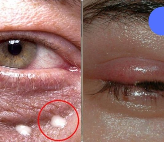 8 სიგნალი, რომლითაც თვალები ჯანმრთელობის პრობლემებზე მიგვანიშნებს,გაიგე მეტი