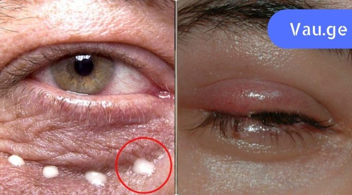 8 სიგნალი, რომლითაც თვალები ჯანმრთელობის პრობლემებზე მიგვანიშნებს,გაიგე მეტი