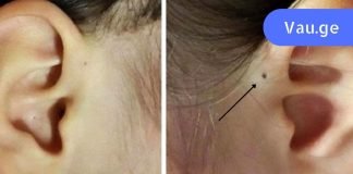 ასეთი ნახვრეტი თუ გაქვს ყურზე ყურადღება მიაქციეთ.