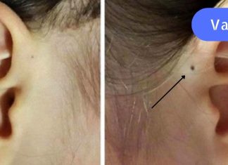 ასეთი ნახვრეტი თუ გაქვს ყურზე ყურადღება მიაქციეთ.