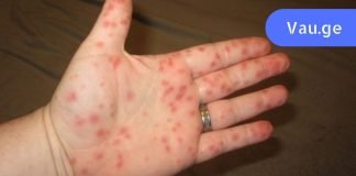 ყურადღება – ახალი ვირუსის ეპიდემია! ყველა მშობელმა უნდა იცოდეს ეს სიმპტომები.