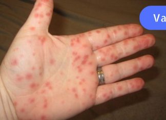 ყურადღება – ახალი ვირუსის ეპიდემია! ყველა მშობელმა უნდა იცოდეს ეს სიმპტომები.