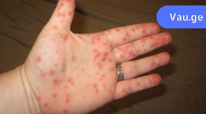 ყურადღება – ახალი ვირუსის ეპიდემია! ყველა მშობელმა უნდა იცოდეს ეს სიმპტომები.