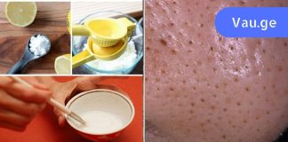 აღარ დაგჭირდებათ ექიმთან სიარული, ბიუჯეტური ხრიკი შავი წერტილებისგან თავის დასაღწევად.