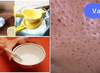 აღარ დაგჭირდებათ ექიმთან სიარული, ბიუჯეტური ხრიკი შავი წერტილებისგან თავის დასაღწევად.