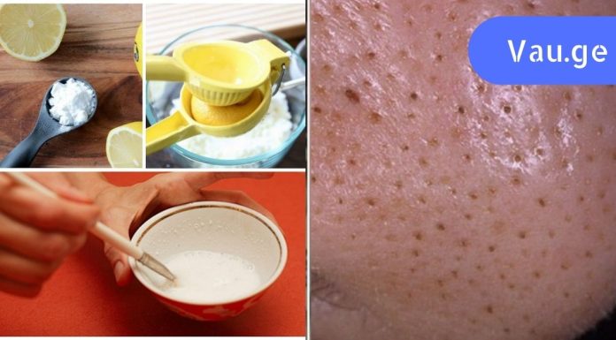 აღარ დაგჭირდებათ ექიმთან სიარული, ბიუჯეტური ხრიკი შავი წერტილებისგან თავის დასაღწევად.