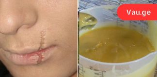 მხოლოდ ეს 3 ინგრედიენტი დამეხმარა ნაწიბურების მოშორებაში!