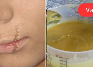 მხოლოდ ეს 3 ინგრედიენტი დამეხმარა ნაწიბურების მოშორებაში!