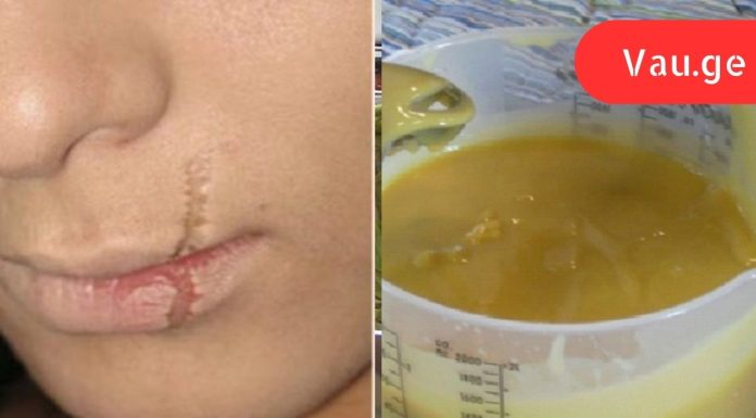 მხოლოდ ეს 3 ინგრედიენტი დამეხმარა ნაწიბურების მოშორებაში!