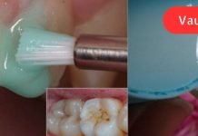 ეფექტური კბილების გათეთრება სახლში: უკეთესია, ვიდრე პროფესიონალური გაწმენდა!