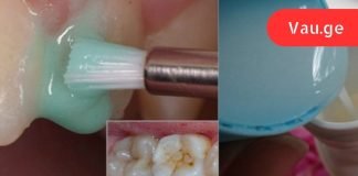 ეფექტური კბილების გათეთრება სახლში: უკეთესია, ვიდრე პროფესიონალური გაწმენდა!