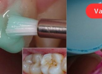 ეფექტური კბილების გათეთრება სახლში: უკეთესია, ვიდრე პროფესიონალური გაწმენდა!