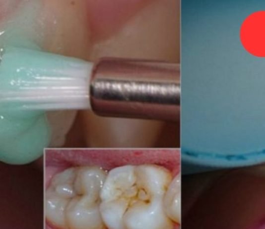 ეფექტური კბილების გათეთრება სახლში: უკეთესია, ვიდრე პროფესიონალური გაწმენდა!